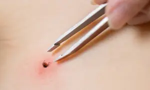 Pęseta usuwa zdrapanego kleszcza z zaczerwienionej skóry.