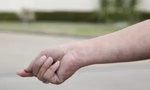 Różowe plamki na skórze ręki mogą być jednym z objawów białaczki.