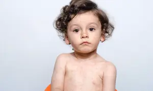 Dziecko z wysypką na skórze.