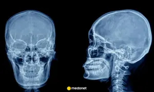RTG czaszki z przodu i z profilu. Obraz może sugerować rozległy udar mózgu, wymagający pilnej diagnostyki.