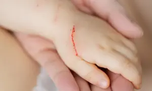 Dziecięca dłoń z krwawiącym zadrapaniem.