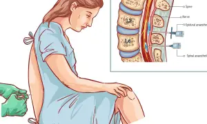 Ilustracja przedstawia kobietę w szpitalnej koszuli, której podawane jest znieczulenie podpajęczynówkowe.