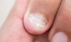 Zbliżenie na palec z uszkodzonym paznokciem, widoczne białe łuszczące się fragmenty.