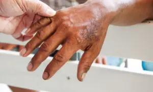 Dłoń z widocznymi zmianami skórnymi, badana przez inną dłoń.
