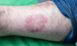 Rumieniowa wysypka na nodze, przypominająca ślad po kleszczu, widoczna pod dżinsami.