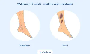 Wybroczyny i siniaki na nogach mogą być objawem białaczki. Ilustracja pokazuje nogę z licznymi czerwonymi plamkami (wybroczyny) i drugą nogę z dużymi, ciemnymi siniakami.