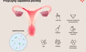 Ilustracja przedstawia przyczyny zapalenia pochwy: cukrzyca, wilgotna bielizna, irygacja, środki higieny intymnej, leki, infekcje, zaburzenia hormonalne. Widoczny jest powiększony obraz bakterii.