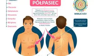 Ilustracja przedstawia nietypowe objawy półpaśca: ból, pieczenie, mrowienie i wysypkę w formie pasa pęcherzy na tułowiu.