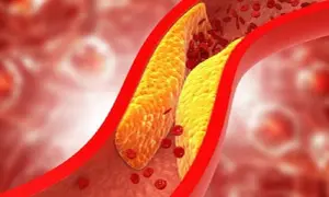 Złogi tłuszczowe zwężające naczynie krwionośne, utrudniające przepływ czerwonych krwinek. Lipoproteina a cena jest kluczowa w ocenie ryzyka sercowo-naczyniowego.