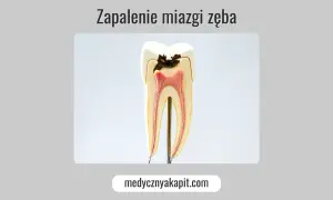 Model zęba ukazujący próchnicę sięgającą miazgi, co prowadzi do zapalenia miazgi.