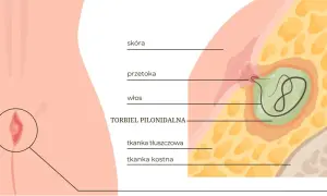Ilustracja anatomiczna torbieli pilonidalnej z widocznym włosem i przetoką.