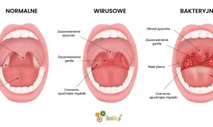 Porównanie gardła: normalne, wirusowe i bakteryjne. Widoczne migdałki, język i gardło.