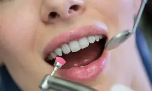 Zbliżenie na usta kobiety podczas zabiegu fluoryzacji zębów z użyciem szczoteczki i lusterka dentystycznego.