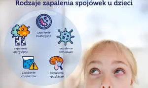 Rodzaje zapalenia spojówek u dzieci: alergiczne, bakteryjne, wirusowe, chemiczne, grzybicze.