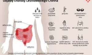 Ilustracja przedstawia schemat jelit z zaznaczonymi objawami choroby Leśniowskiego-Crohna.