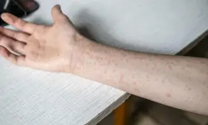 Ręka i przedramię pokryte drobną, czerwoną wysypką.