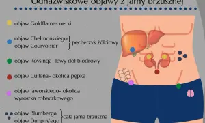 Objaw Jaworskiego lokalizuje się w okolicy wyrostka robaczkowego, zaznaczony na różowo na schemacie jamy brzusznej.