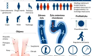 Grafika przedstawia żylaki, ich objawy, czynniki ryzyka (genetyka, ciąża, wiek, nadwaga, długie stanie, siedzący tryb życia) oraz profilaktykę (dieta, ćwiczenia, wyroby kompresyjne, skleroterapia, laser, operacja).