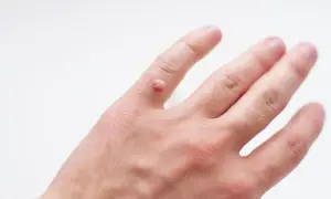 Czy można zarazić się kurzajką? Poznaj prawdę o infekcji HPV