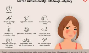 Toczeń rumieniowaty układowy - objawy: ból głowy, obrzęki, wypadanie włosów, owrzodzenia, gorączka, utrata wagi, zmęczenie, wysypka, problemy psychiczne, bóle stawów.