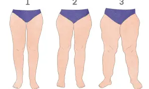 Ilustracja przedstawiająca nogi kobiet z różnym stopniem lipodemi.