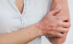 Skóra ręki i przedramienia pokryta suchymi, łuszczącymi się zmianami, które mogą być objawem pelagry.