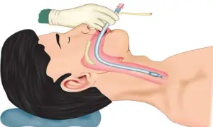 Ilustracja przedstawia intubację pacjenta, gdzie ręka w rękawiczce wprowadza rurkę intubacyjną do dróg oddechowych.