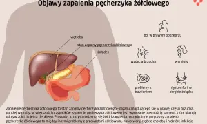 Ilustracja anatomiczna przedstawiająca wątrobę, żołądek i pęcherzyk żółciowy z objawami zapalenia.