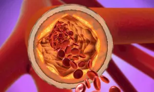 Przekrój tętnicy z widocznymi złogami cholesterolu i czerwonymi krwinkami.