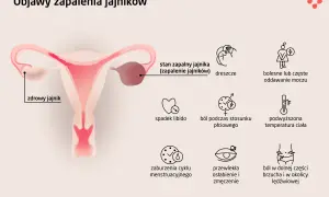 Ilustracja przedstawia budowę narządów rodnych kobiety z zaznaczonym zdrowym jajnikiem i stanem zapalnym jajnika. Wymienione objawy zapalenia jajników to m.in. ból brzucha.