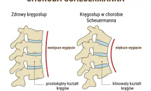 Porównanie zdrowego kręgosłupa z kręgosłupem w chorobie Scheuermanna. W chorobie Scheuermanna kręgi przybierają klinowaty kształt, co powoduje większe wygięcie kręgosłupa.