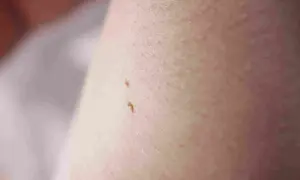 Zbliżenie na skórę z widocznymi dwoma małymi, brązowymi włókniakami.