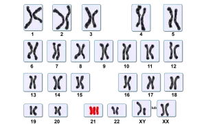 Zestawienie różnych par chromosomów, w tym jedna nieprawidłowa triada.