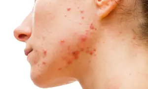 Zaburzenia hormonalne a objawy skórne: jak rozpoznać i leczyć problemy skóry