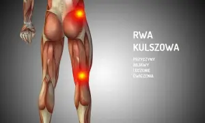 Rwa kulszowa a ból kolana: objawy, które musisz znać