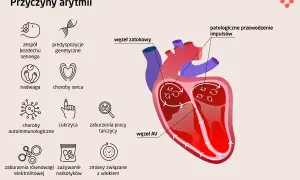 Ilustracja przedstawia przyczyny arytmii serca: bezdech senny, predyspozycje genetyczne, nadwagę, choroby serca, choroby autoimmunologiczne, cukrzycę, zaburzenia pracy tarczycy, zaburzenia elektrolitowe, narkotyki i wiek.