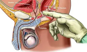 Ilustracja przedstawia badanie per rectum, które jest częścią diagnostyki raka prostaty. Dłoń w rękawiczce bada gruczoł krokowy.