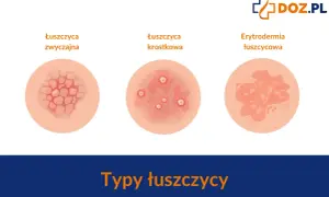 Ilustracje pokazują różne typy łuszczycy: łuszczycę zwyczajną, krostkową i erytrodermię łuszczycową.