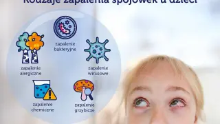 Rodzaje zapalenia spojówek u dzieci: alergiczne, bakteryjne, wirusowe, chemiczne, grzybicze.