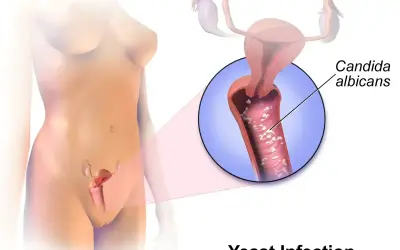 Ilustracja przedstawia kobiece narządy rodne z powiększeniem ukazującym Candida albicans, grzybicę pochwy. Objawy candida mogą być uciążliwe.