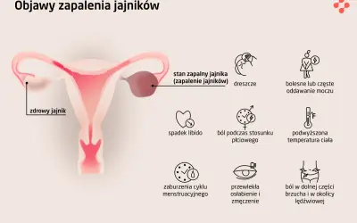 Ilustracja przedstawia budowę narządów rodnych kobiety z zaznaczonym zdrowym jajnikiem i stanem zapalnym jajnika. Wymienione objawy zapalenia jajników to m.in. ból brzucha.