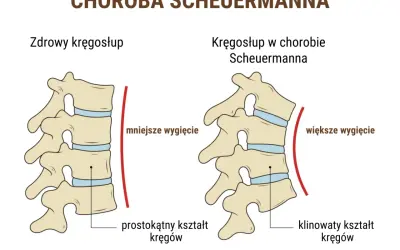Porównanie zdrowego kręgosłupa z kręgosłupem w chorobie Scheuermanna. W chorobie Scheuermanna kręgi przybierają klinowaty kształt, co powoduje większe wygięcie kręgosłupa.