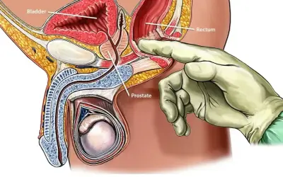 Ilustracja przedstawia badanie per rectum, które jest częścią diagnostyki raka prostaty. Dłoń w rękawiczce bada gruczoł krokowy.