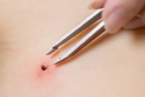 Pęseta usuwa zdrapanego kleszcza z zaczerwienionej skóry.