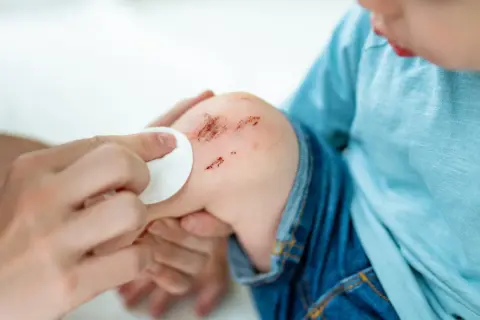 Dziecko z otartym kolanem, któremu przemywa się ranę. To przypomina, co to hemofilia i jak ważne jest dbanie o bezpieczeństwo.