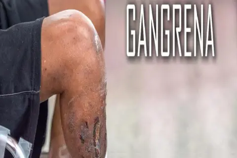 Fragment nogi z widocznymi ranami i tekstem "GANGRENA".