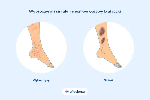 Wybroczyny i siniaki na nogach mogą być objawem białaczki. Ilustracja pokazuje nogę z licznymi czerwonymi plamkami (wybroczyny) i drugą nogę z dużymi, ciemnymi siniakami.