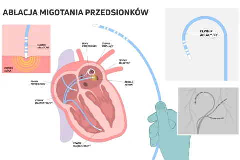 Ilustracja pokazuje, jak ablacja serca co to jest: cewniki wprowadzane do serca, by zlokalizować i zniszczyć źródło arytmii.