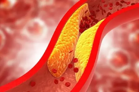 Złogi tłuszczowe zwężające naczynie krwionośne, utrudniające przepływ czerwonych krwinek. Lipoproteina a cena jest kluczowa w ocenie ryzyka sercowo-naczyniowego.