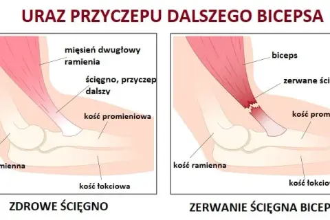 Naderwany biceps: 5 kluczowych objawów, które musisz znać